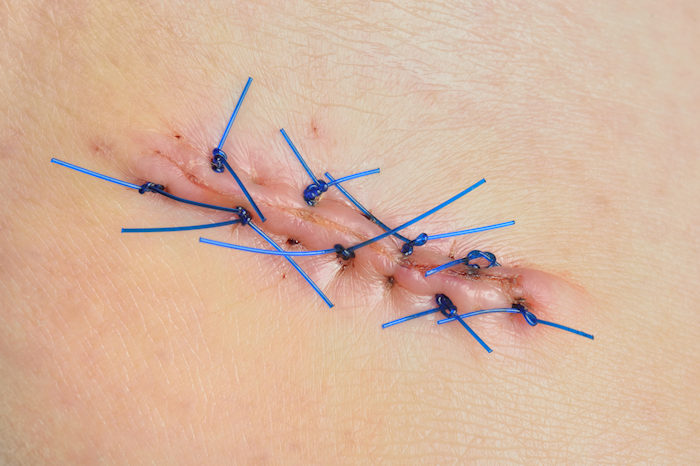 Minor surgical sutures